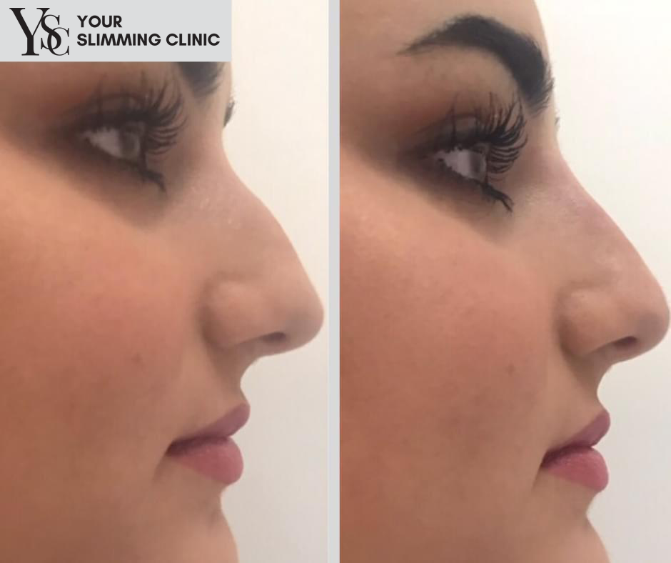 Your Slimming Clinic Bournemouth Liquid Rhinoplasty – Nose Straightening